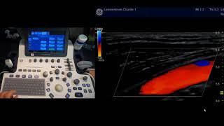 Farbkodierte Duplexsonographie 11SchrittMethode [upl. by Bryan235]