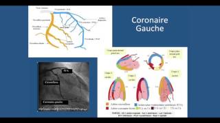 Coronarographie et Angioplastie coronaire [upl. by Nallek]