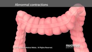 Irritable Bowel Syndrome IBS [upl. by Oratnek]