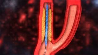 Carotid Artery Stenting video [upl. by Naitsirhc996]