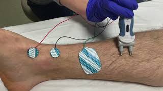 Saphenous Nerve Conduction Studies Proximal and Distal techniques [upl. by Harriott]