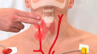 Carotid Sinus Massage 2017 [upl. by Evilc214]