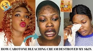 STORYTIME HOW CAROTONE BLEACHING CREAM DESTROYED MY SKIN😭😭 [upl. by Nowd586]