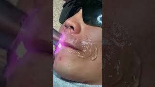 Diode Laser Hair Removal Permanent [upl. by Cattan618]