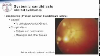 Candida Systemic Candidiasis [upl. by Wojak]