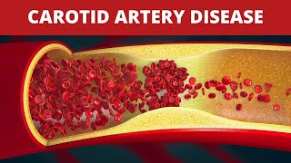 Treatment of Carotid Artery Disease [upl. by Sivrup996]