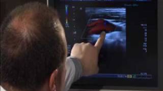 Carotid Artery Ultrasound [upl. by Constantina807]