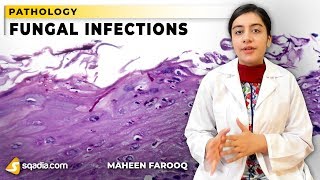 Fungal Infections  Candida  Pathology Video Lectures  VLearning  sqadiacom [upl. by Cecilia]