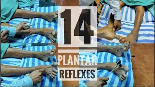 14 Abnormal plantar reflexes Babinski equivalents [upl. by Leahcar]