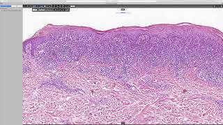 Lichenoid keratosis Phillip H McKee Antonina Kalmykova amp CSD Health Care [upl. by Demaggio]