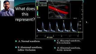 Secrets of Carotid Ultrasound [upl. by Rodmun]