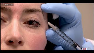 I almost RUINED my face  Botox Masseter [upl. by Kacie]