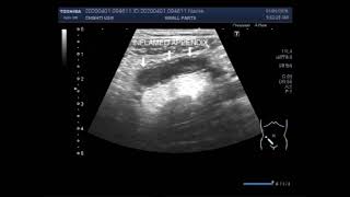 Ultrasound Video showing Acute appendicitis or inflamed appendix [upl. by Ottilie]