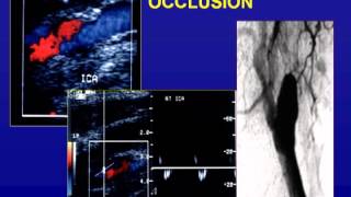 Ultrasound of the Carotid Arteries [upl. by Donahoe972]