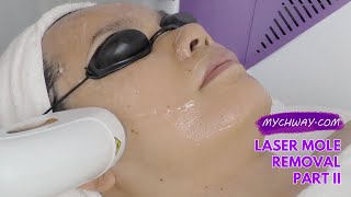 Laser Hair Removal Diode Laser Hair Removal 808nm Laser Painless myChway GX002 Part II Face [upl. by Delanty]