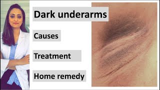 How to get rid of Dark underarms  causes treatment home remedy Dermatologist  Dr Aanchal [upl. by Tamer992]